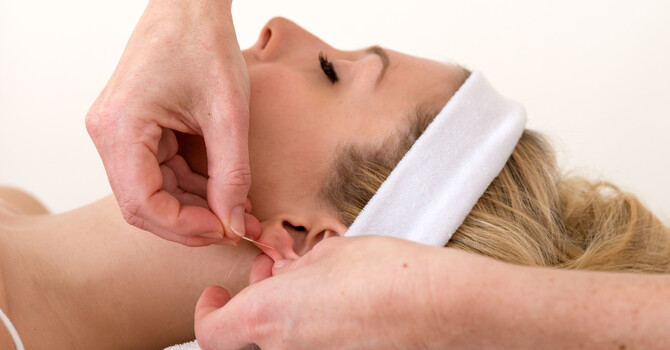 Ear Acupuncture